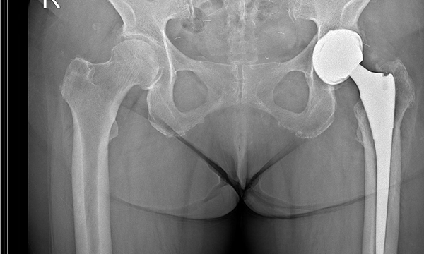 인공관절반치환술